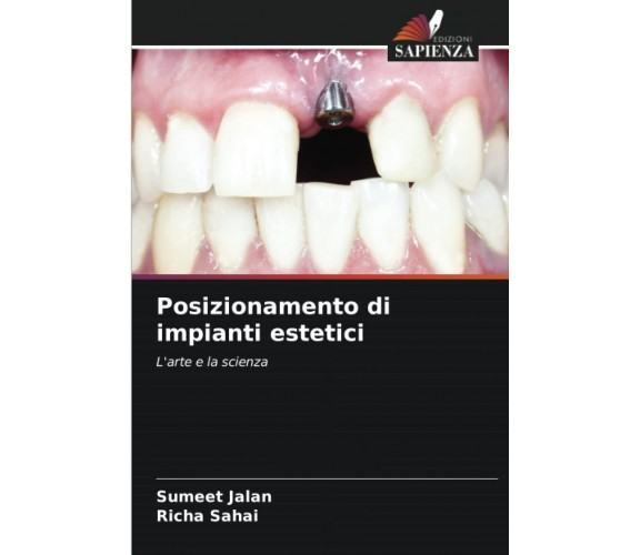 Posizionamento di impianti estetici: L'arte e la scienza - Sumeet Jalan - 2022